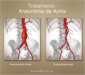 Cirurgia-aneurisma-aorta-endoprotese-stent