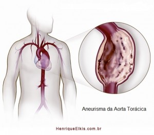 Cirurgia-aneurisma-aorta-toracica-endoprotese-stent